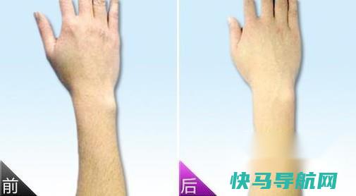 光子永久脱毛价格 第2张