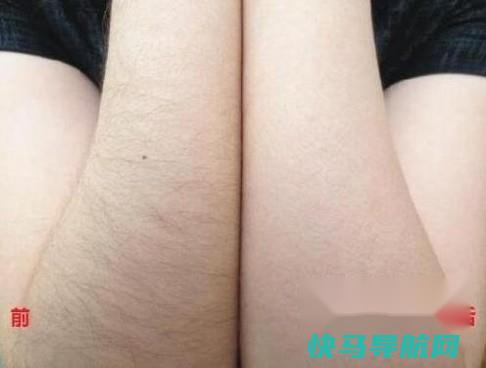 光子永久脱毛价格 第3张