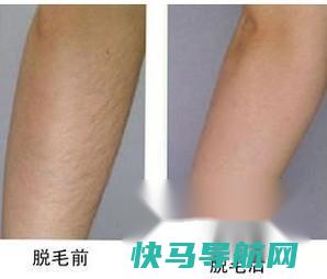 光子永久脱毛价格 第4张